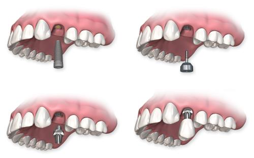 Trồng răng implant